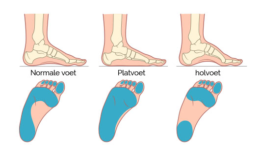 Platvoet en holvoet