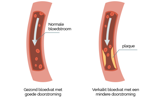 Bloedvaten diabetes