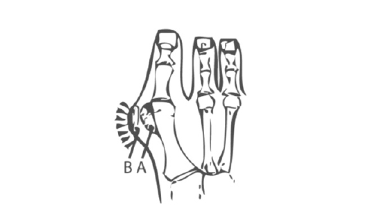 hallux valgus