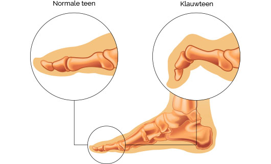 klauwtenen