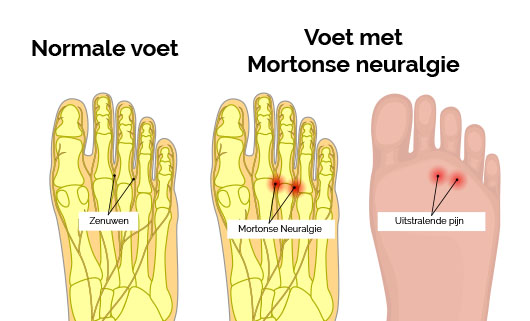 Mortonse neuralgie